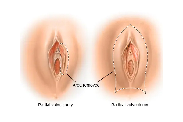 Vulva Cancer Surgery